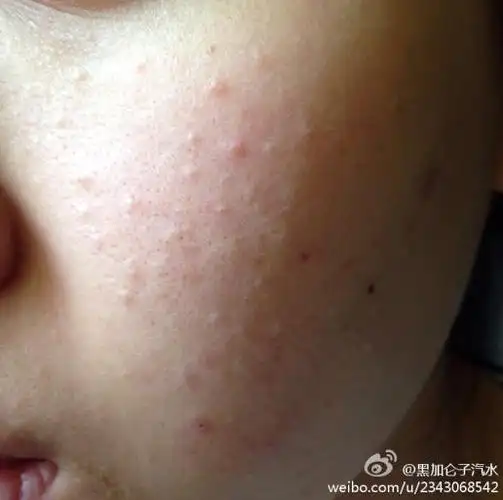 请问脸上这些一粒粒的是痘痘吗?还是毛孔堵塞?喝了几天中药没有什么?