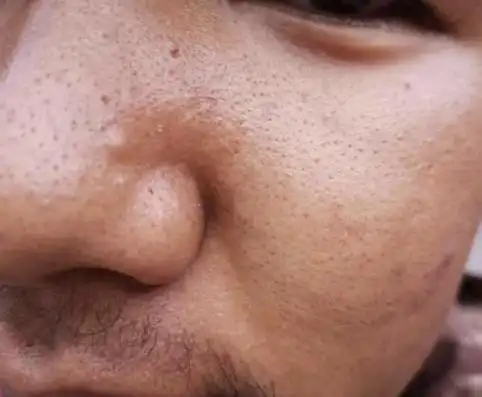 男生毛孔粗大皮肤很黑很粗糙怎么办