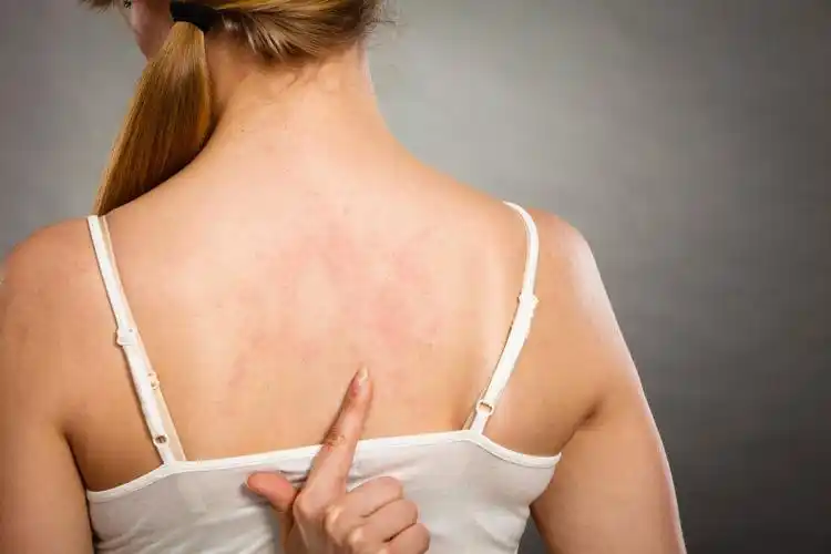 上通常是指神经性皮炎,是一种常见的以剧烈瘙痒为主要表现的皮肤病,可