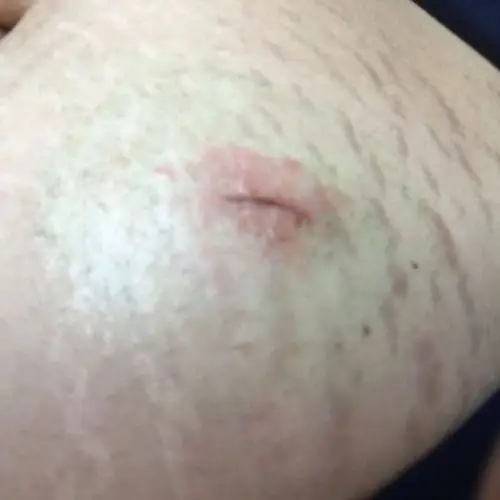 宫外孕微创手术二十天后刀口上起了好多红疙瘩,好痒!