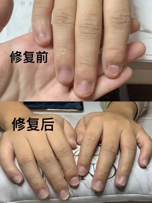 啃咬甲属于一种病理性的指甲 不断的啃咬自己的指甲使得甲床越来越短