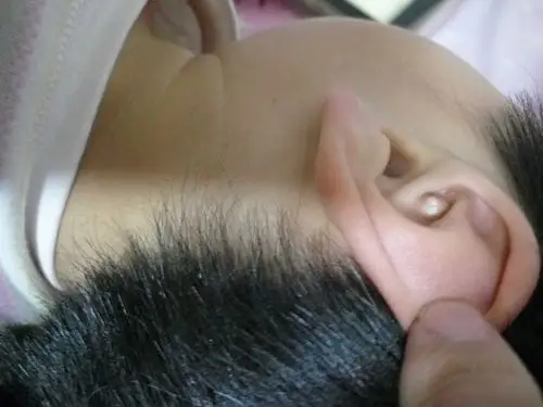 宝宝今年3岁,左边耳廓里从出生就有个圆疙瘩,软的,跟皮肤一样,前