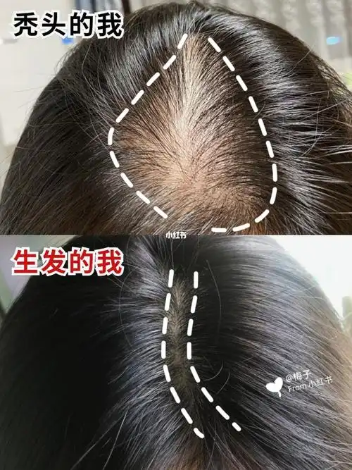 超简单生发方法60无经验防脱生发竟成功了