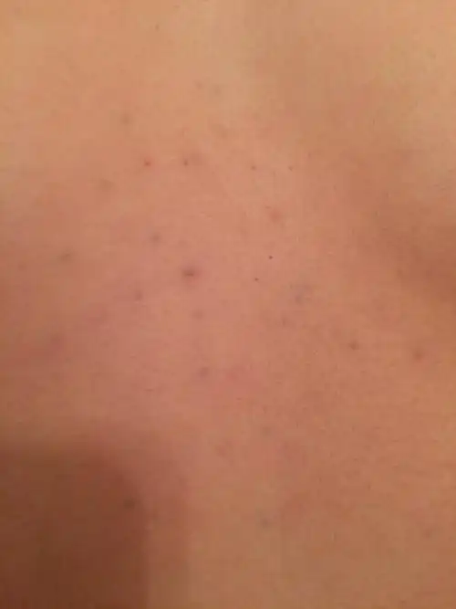 胸口中心长了一些像黑头一样的东西 但是长在皮肤里面 没有办法挤 不