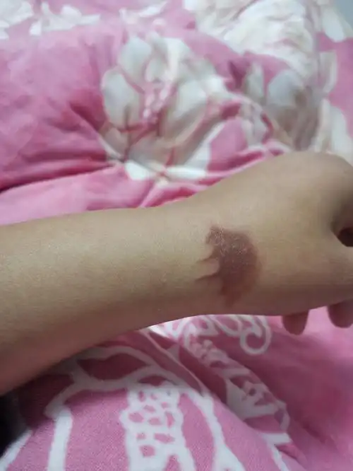 就想知道那个壶水多少℃[捂脸][捂脸]多深的印记啊,这几天擦了烫伤膏