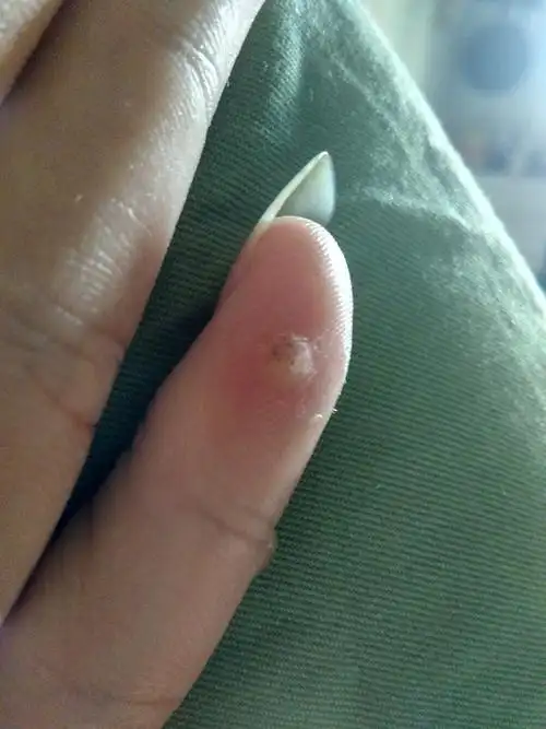 这种肉瘤在我手指上有一两年了最初的时候只有一个现在又长出了两