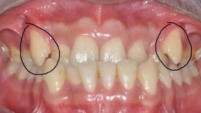 "虎牙"突出来,拔掉就好了?(口腔科普第十八期) - 好大夫在线