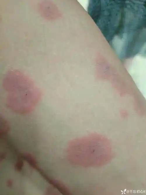 皮疹待查