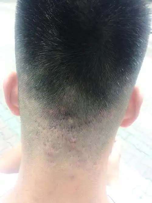 脑袋后面长了很多包,冬天时候也有,刚上大学,来到了外地.