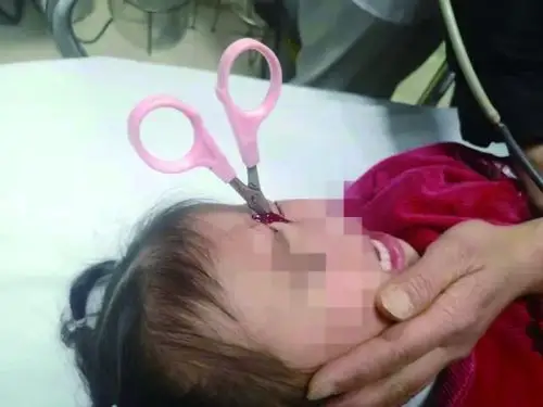 一把剪刀插入2岁女童眼眶 儿童眼外伤致盲率高达60%~70%,家长一定要看