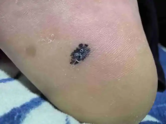 脚底突然长出个黑的