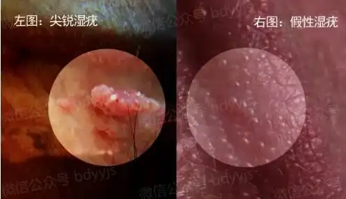 尖锐湿疣属于常见的性传播疾病,一般有过不洁性行为的人才容易感染该