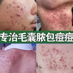治头皮毛囊炎专用膏药头部脖子前胸后背私处马拉色菌痘痘中药酊疗