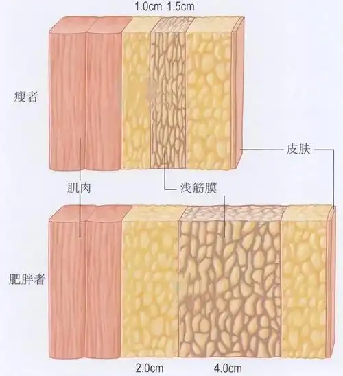 整形医生韩炜从解剖学角度解读大腿吸脂