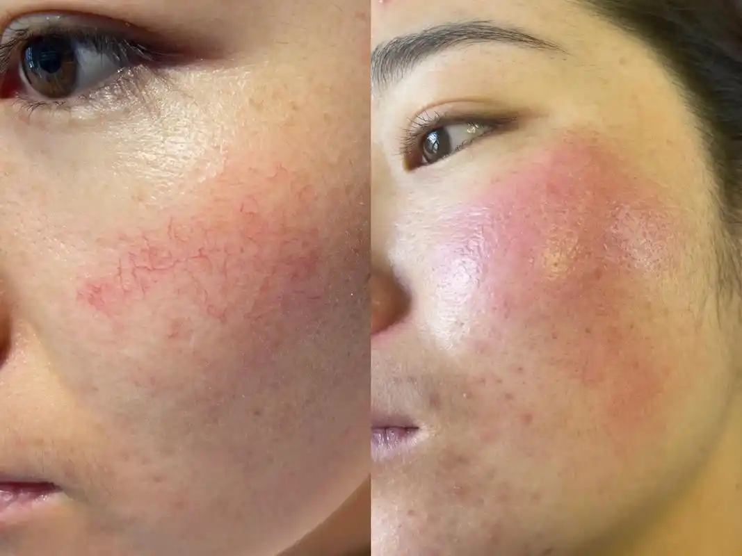 解决任何皮肤问题 #怎么让脸部变得又干净又白 红血丝的效果 - 抖音