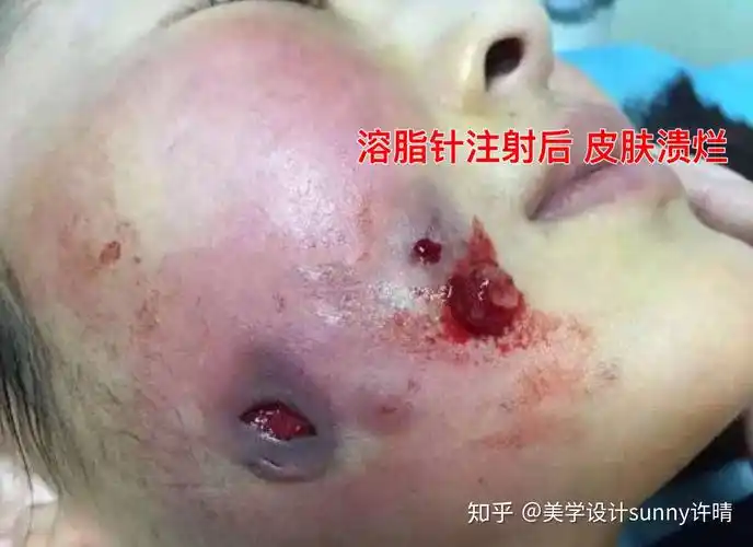 溶脂针是什么副作用大吗国内允许打吗溶脂针面部溃烂毁容