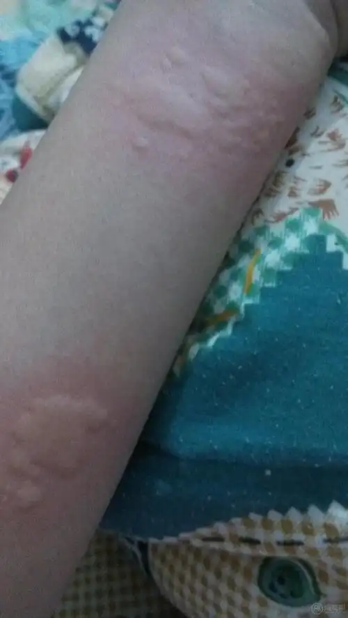 普通过敏出红疙瘩