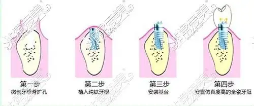种植体即人工牙根,种植牙是由种植体 基台 牙冠的结构所组成.