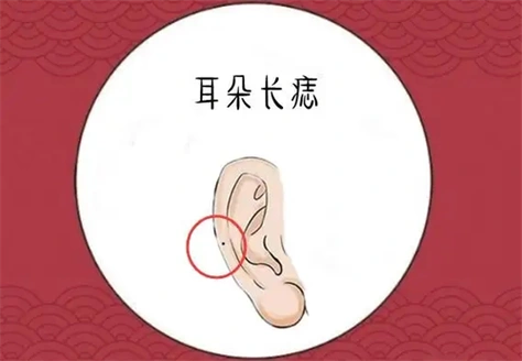 耳朵上的痣图解大全 耳朵上的痣图解大全对照表-善吉网