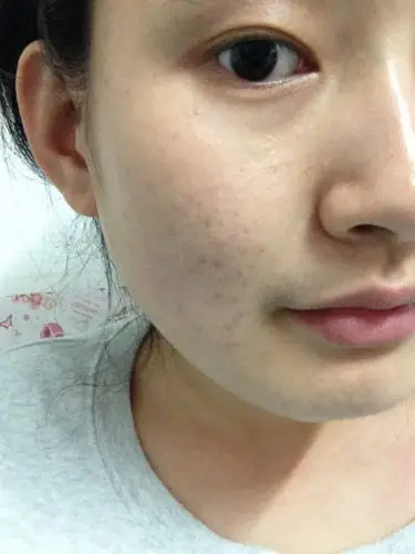 朋友们,我同学的脸上爱出油,还爱长痘痘,毛孔粗大,有时候脸上还能挤出