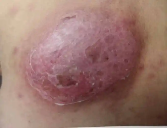 前胸后背,头皮,私处反复长红疙瘩,小心是毛囊炎作祟_医生_治疗_症状