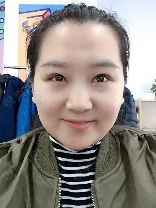 上睑下垂矫正术后45天_全切双眼皮术后45天_眼型矫正术后45天_眼综合