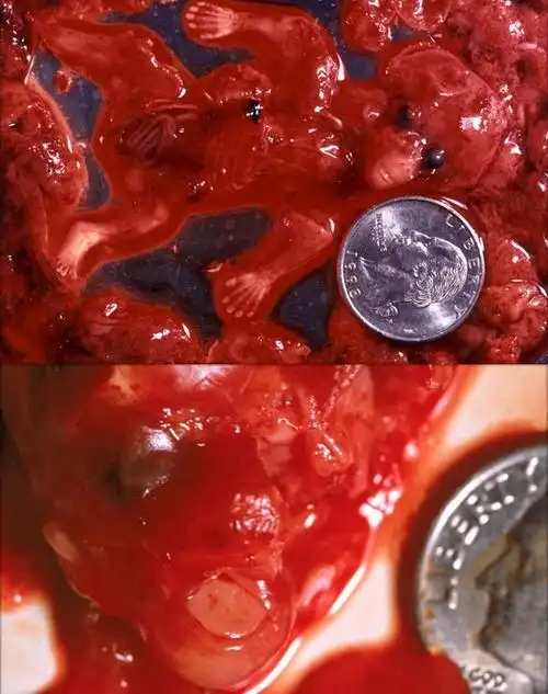 早期堕胎:7周大的胎儿     真 爱生命～ 再送上一个