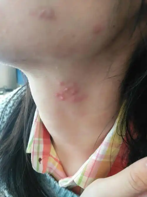 脖子上一宿突然长这么多疙瘩,很疼,怀疑吃了老鼠碰过东西,请问这个