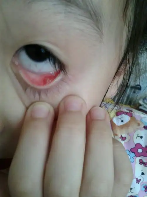 2013-12-03 蔡亚平 医师 宝宝两岁上眼皮长麦粒肿三个月了,医生给挑过