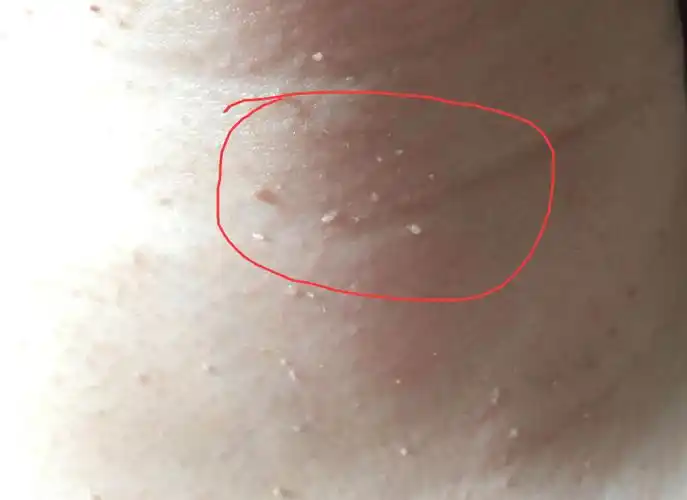 23:14 答: 患者的病情考虑是丝状疣的病情症状脖子上的小啾啾