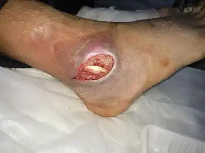 之后伤口不愈合,周围皮肤发黑,渗液,当地换药无好转,为进一步治疗至我