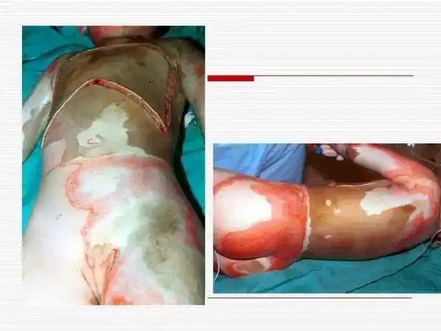 重度烧伤病人的护理各种方法和措施太全了