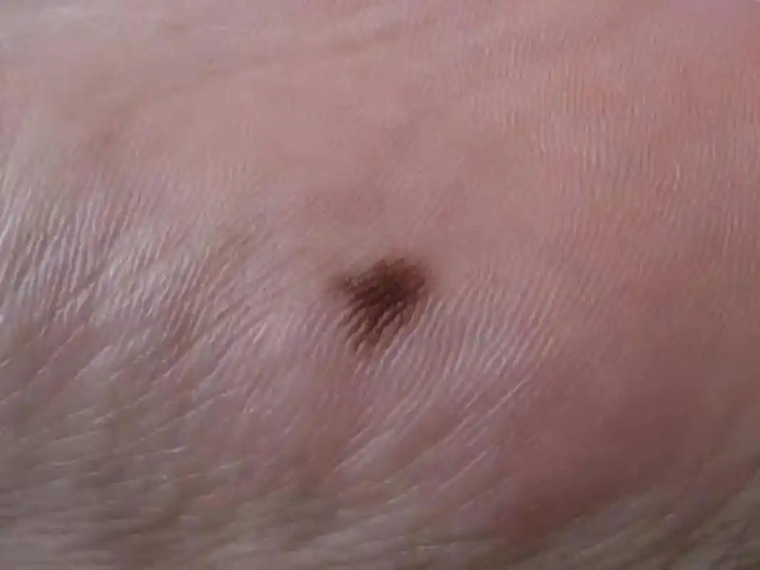 昨天晚上,我帮老婆捏脚,结果在她脚底发现了2颗痣,我记得以前没有的