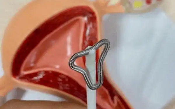 节育环有几种类型 - 避孕环不取对身体有害吗 - 节育环图片 - 柚喜