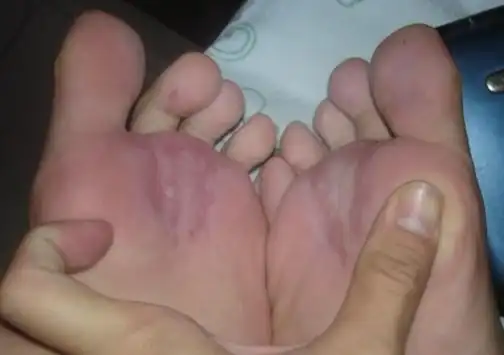 脚掌突然红红的 痛痛的 可是好像也没创伤