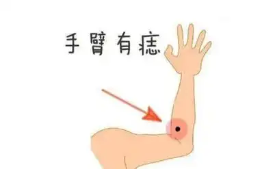 女人手臂各种痣图解 女人手臂各种痣图解图插图2