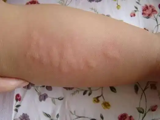 宝宝科普:湿疹,痱子,荨麻疹,水痘等区别与护理