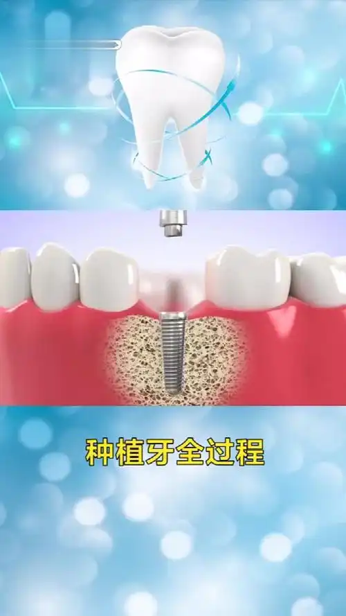 北京维嘉口腔种植牙过程,非常详细