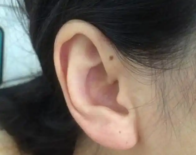 好痣可招贵人帮助,恶痣则败尽家财,耳朵上有痣,到底是福是祸?