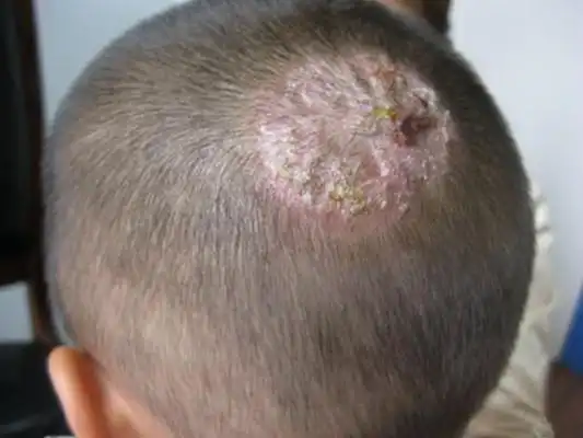 头癣图片_头癣症状表现图片大全_有来医生