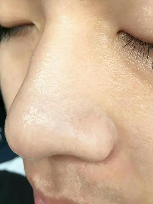 毛孔粗大 黑头粉刺!男士护肤美白3步曲!