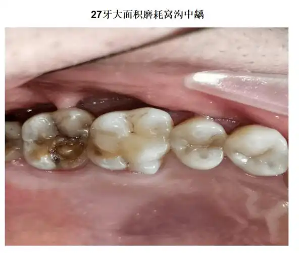 【病例】上颌第二恒磨牙大面积磨耗emax瓷嵌体微创修复