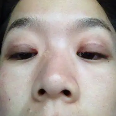 双眼皮12的时候突然起了一个小疙瘩到底是增生还是线结反应啊严重不