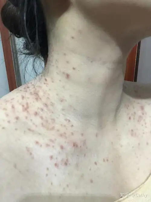 马拉色菌毛囊炎怎么治