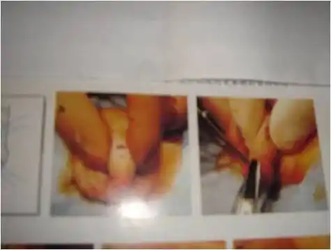 小儿包茎治疗的进展