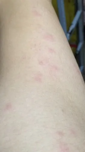 热心网友 应该是过敏了 追问 有危险么?