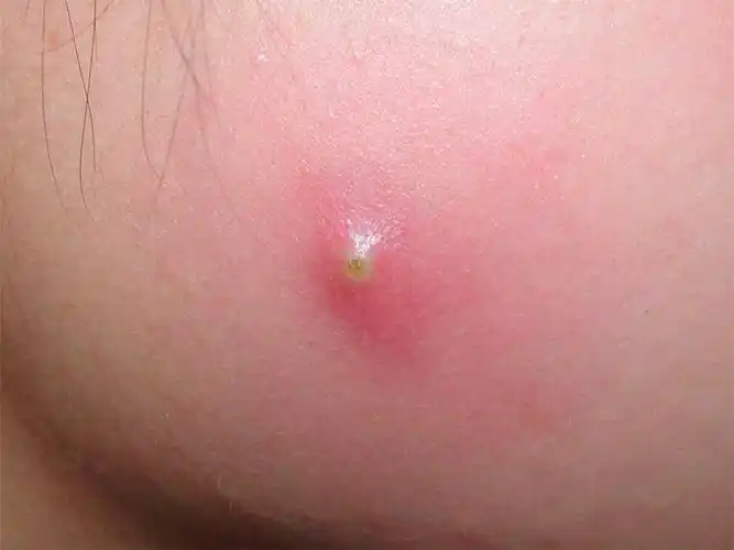 毛囊炎,疖,疖病,疖肿,痈,这些名词,您都了解吗?