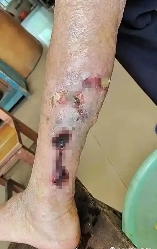 老人下肢动脉闭塞并溃疡被建议截肢,加强营养两周免截肢_伤口_患者