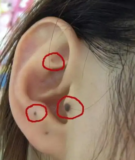 耳朵长痣的位置与命运,耳朵上各处痣的命运图