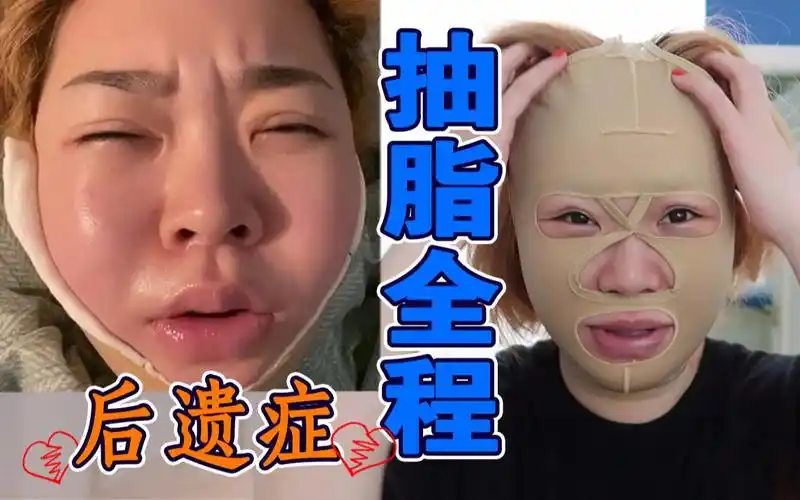 【千万别抽脂】实拍全程 后遗症!瘦了54斤抽脂后我脸僵了!